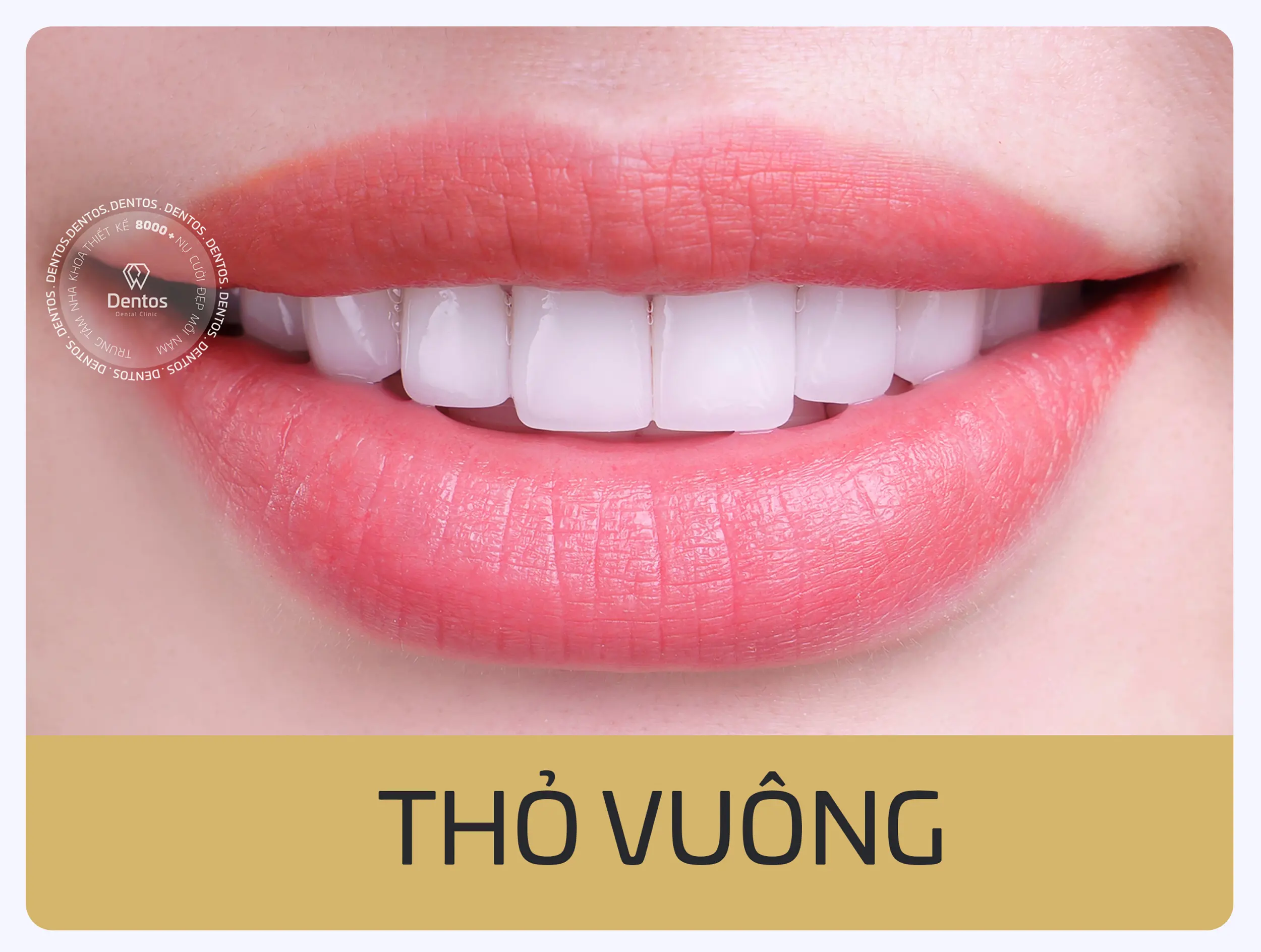 Bọc răng sứ phong thủy Dentos - Dáng răng thỏ vuông